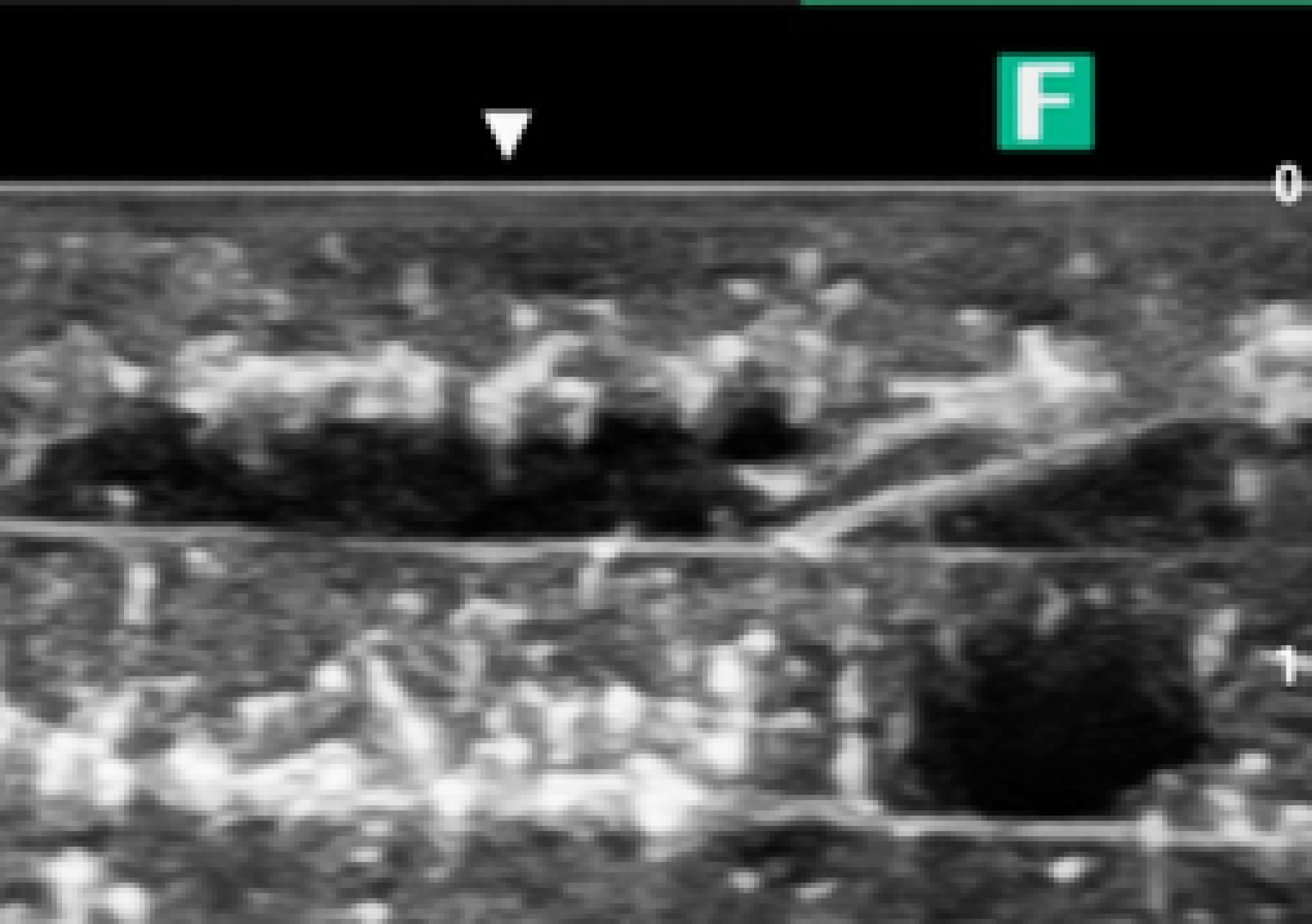 エコー下での血管と穿刺針の様子